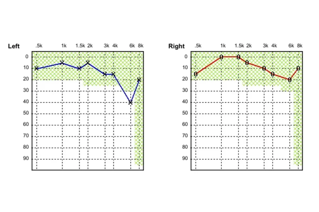 Audiometric Testing Sydney